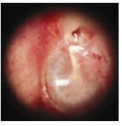 otitis_media_aguda/periodo_congestivo_1