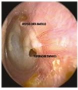 otitis_media_aguda/periodo_perforado