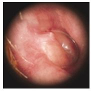 otitis_media_aguda/periodo_supurado_1