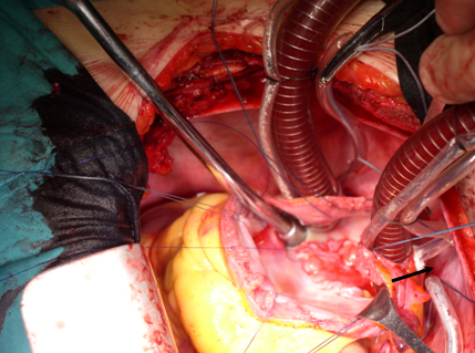 cirugia_mixoma_cardiaco/SIA_parche_pericardico cirugia_mixoma_cardiaco/SIA_parche_pericardico