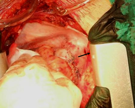 cirugia_mixoma_cardiaco/ampliacion_AD_parche cirugia_mixoma_cardiaco/ampliacion_AD_parche