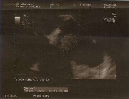 cirugia_mixoma_cardiaco/ecocardiograma_AD_2 cirugia_mixoma_cardiaco/ecocardiograma_AD_2
