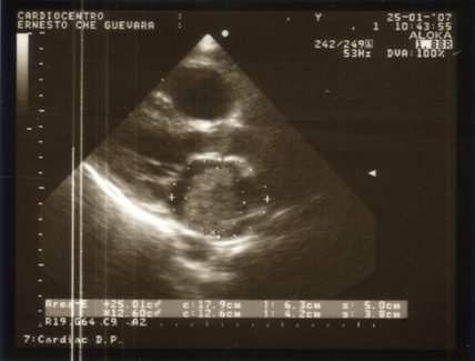 cirugia_mixoma_cardiaco/ecocardiograma_AI_1