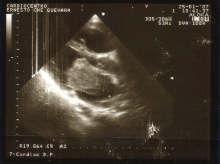 cirugia_mixoma_cardiaco/ecocardiograma_AI_2 cirugia_mixoma_cardiaco/ecocardiograma_AI_2