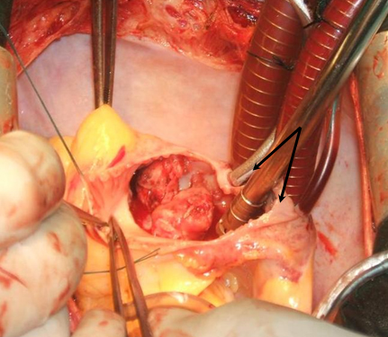 cirugia_mixoma_cardiaco/mixoma_de_AD cirugia_mixoma_cardiaco/mixoma_de_AD