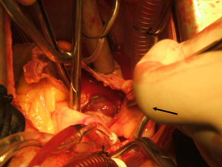 cirugia_mixoma_cardiaco/mixoma_de_AI cirugia_mixoma_cardiaco/mixoma_de_AI