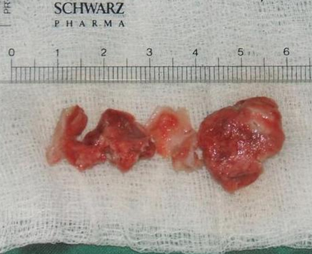 cirugia_mixoma_cardiaco/mixomas_10 cirugia_mixoma_cardiaco/mixomas_10