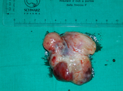 cirugia_mixoma_cardiaco/mixomas_7 cirugia_mixoma_cardiaco/mixomas_7