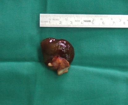 cirugia_mixoma_cardiaco/mixomas_8 cirugia_mixoma_cardiaco/mixomas_8