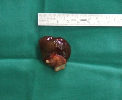 cirugia_mixoma_cardiaco/mixomas_8