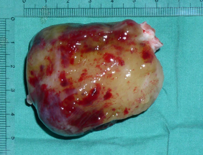 cirugia_mixoma_cardiaco/mixomas_9 cirugia_mixoma_cardiaco/mixomas_9
