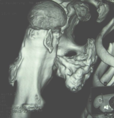 dolor_exostosis_multiple/osteocondroma_TAC_3D