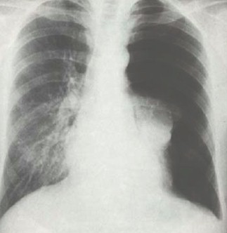 drenaje_pleural_neumotorax/rx_radiografia_torax