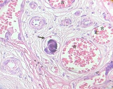 fotografia_microscopio_optico/calcificacion_intraluminal_vascular fotografia_microscopio_optico/calcificacion_intraluminal_vascular