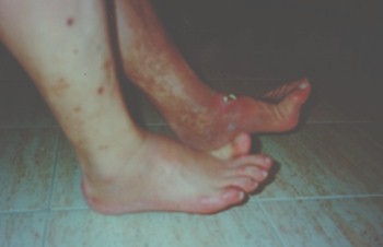 guia_basica_fisioterapia/enfermedad_arterial_oclusiva guia_basica_fisioterapia/enfermedad_arterial_oclusiva