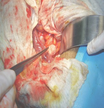 ictericia_obstructiva_litiasis/cirugia_via_biliar ictericia_obstructiva_litiasis/cirugia_via_biliar