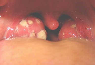 infecciones_respiratorias_agudas/amigalitis_faringoamigdalitis infecciones_respiratorias_agudas/amigalitis_faringoamigdalitis