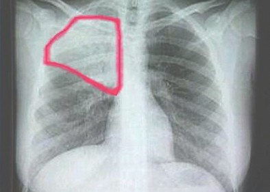 infecciones_respiratorias_agudas/neumonia_rx_radiografia