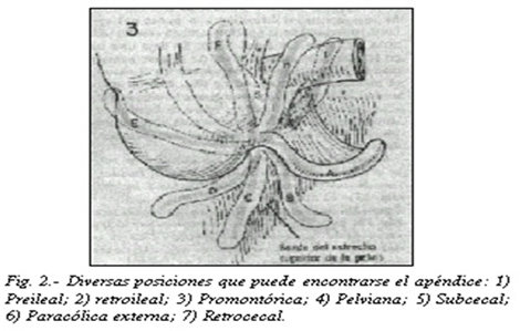 apendicitis_aguda_cirugia/variantes_del_apendice