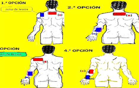 corrientes_excitomotrices/opciones_colocacion_electrodos