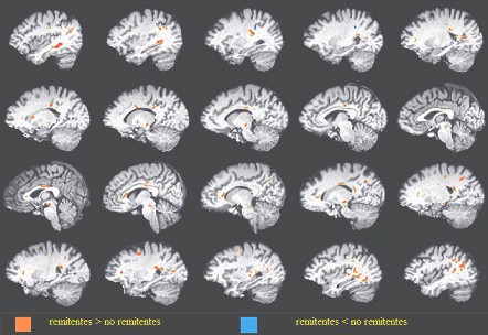 depresion_refractaria_frontolimbica/neuroanatomia_anistropia_fraccional