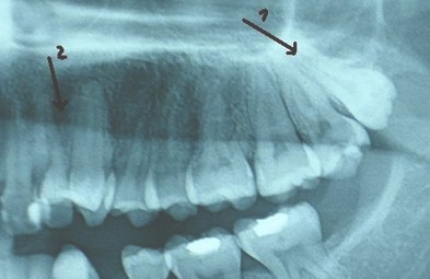 hiperdoncia_multiple_supernumerarios/cuarto_molar_radiografia