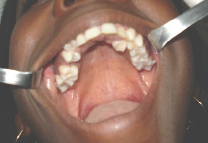 hiperdoncia_multiple_supernumerarios/dientes_piezas_dentarias