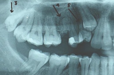 hiperdoncia_multiple_supernumerarios/resto_radicular_dismorfico