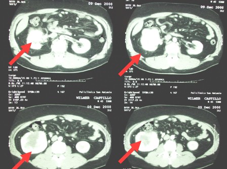hipernefroma_caso_clinico/TAC_tomografia_axial hipernefroma_caso_clinico/TAC_tomografia_axial