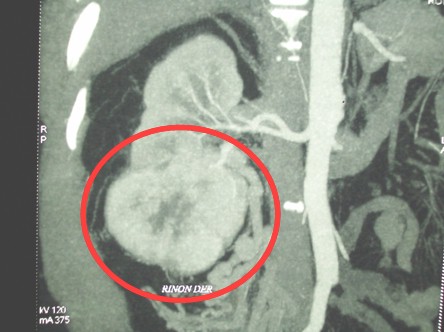 hipernefroma_caso_clinico/imagen_tumor_renal hipernefroma_caso_clinico/imagen_tumor_renal