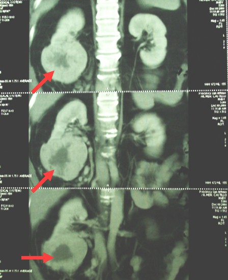 hipernefroma_caso_clinico/imagenes_tumor_renal hipernefroma_caso_clinico/imagenes_tumor_renal