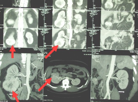 hipernefroma_caso_clinico/urotomografia_con_contraste