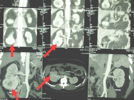 hipernefroma_caso_clinico/urotomografia_con_contraste hipernefroma_caso_clinico/urotomografia_con_contraste