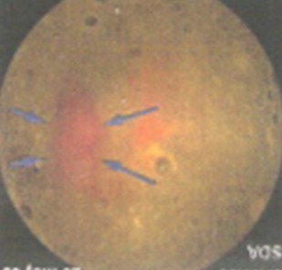 sindrome_Heyde_neurofibromatosis/angiodisplasia_colon_colonica