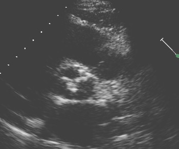 sindrome_Heyde_neurofibromatosis/ecocardiografia_estenosis_aortica