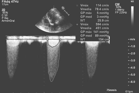 sindrome_Heyde_neurofibromatosis/moderada_estenosis_aortica