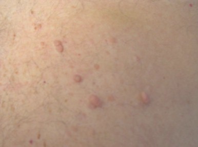 sindrome_Heyde_neurofibromatosis/neurofibroma_neurofibromas_toracicos sindrome_Heyde_neurofibromatosis/neurofibroma_neurofibromas_toracicos