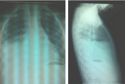 sindrome_toracico_drepanocitosis/radiografia_torax_condensacion