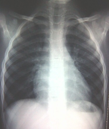 sindrome_toracico_drepanocitosis/resolucion_proceso_pulmonar