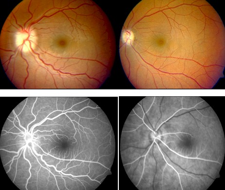 perdida_visual_liposuccion/fluoroangiografia_ojo_ocular