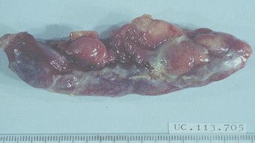 tamiento_apendicitis_aguda/supurada_exudado_cirugia