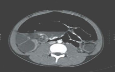 volvulus_volvulo_intestino/TAC_abdomen_pelvis volvulus_volvulo_intestino/TAC_abdomen_pelvis