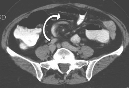 volvulus_volvulo_intestino/TAC_asa_intestinal volvulus_volvulo_intestino/TAC_asa_intestinal
