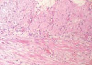 volvulus_volvulo_intestino/anatomia_patologica_histologia volvulus_volvulo_intestino/anatomia_patologica_histologia
