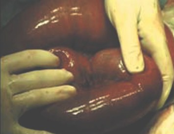 volvulus_volvulo_intestino/cirugia_asa_intestino volvulus_volvulo_intestino/cirugia_asa_intestino