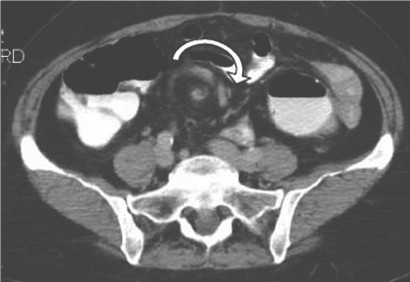 volvulus_volvulo_intestino/giro_asa_intestinal volvulus_volvulo_intestino/giro_asa_intestinal