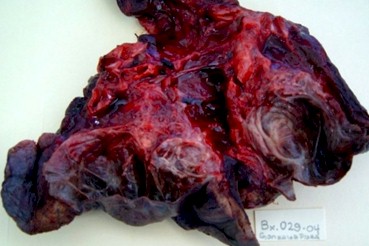 malformaciones_pulmonares_congenitas/AP_quiste_secuestro_pulmonar malformaciones_pulmonares_congenitas/AP_quiste_secuestro_pulmonar