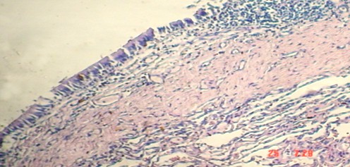 malformaciones_pulmonares_congenitas/epitelio_cilindrico_respiratorio