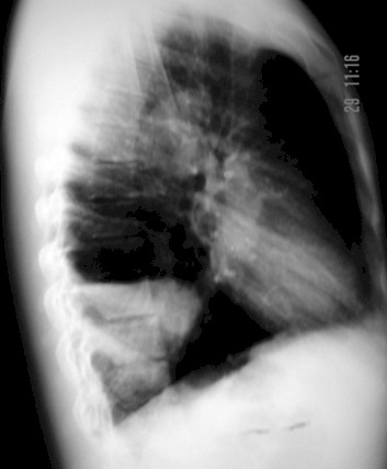 malformaciones_pulmonares_congenitas/quiste_secuestro_malformacion