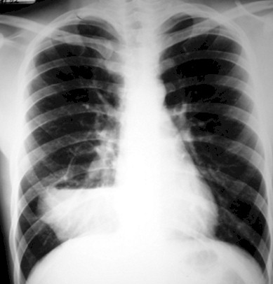 malformaciones_pulmonares_congenitas/quiste_secuestro_pulmonar